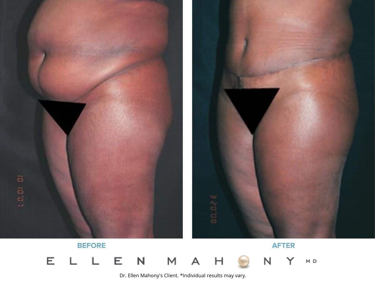 Before and After Image: Case #2455 - left-front-oblique