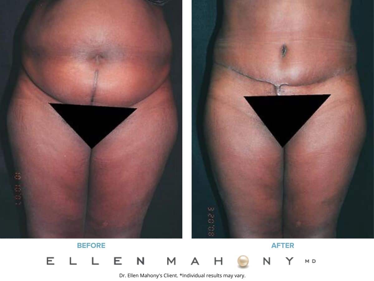 Before and After Image: Case #2455 - front