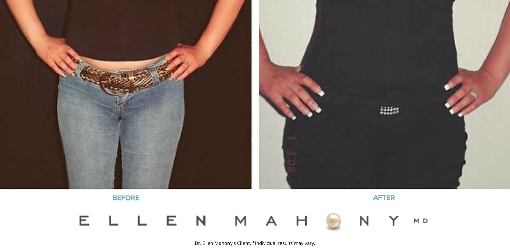 Before and After Image: Case #2462 - front