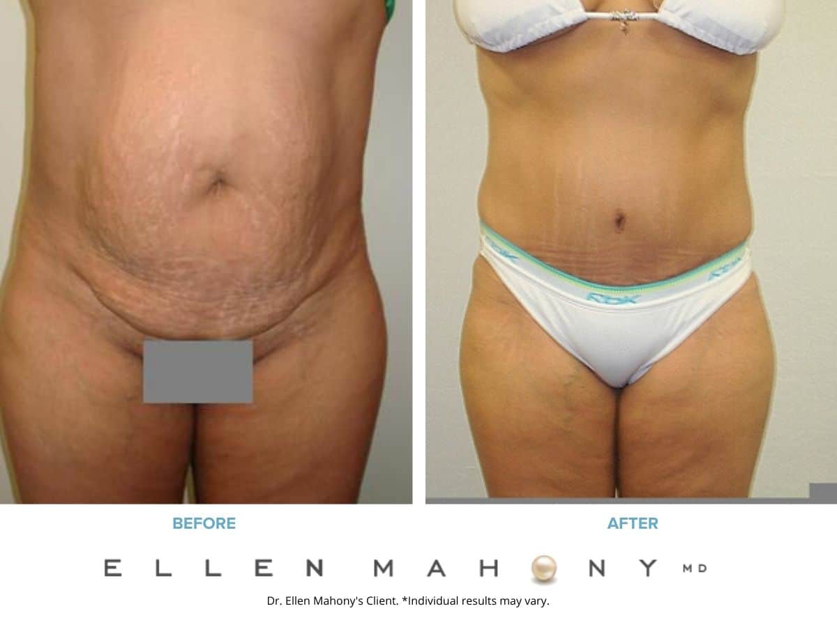 Before and After Image: Case #2469 - front