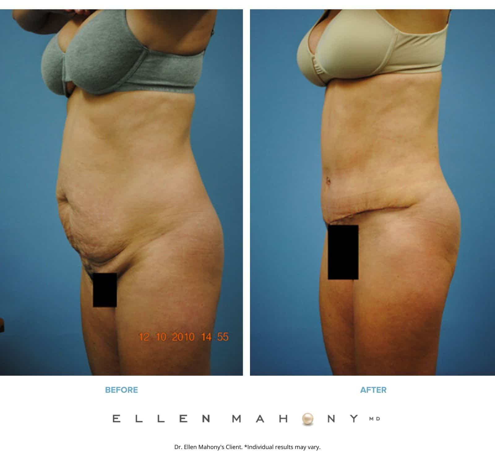 Before and After Image: Case #2490 - left-front-oblique