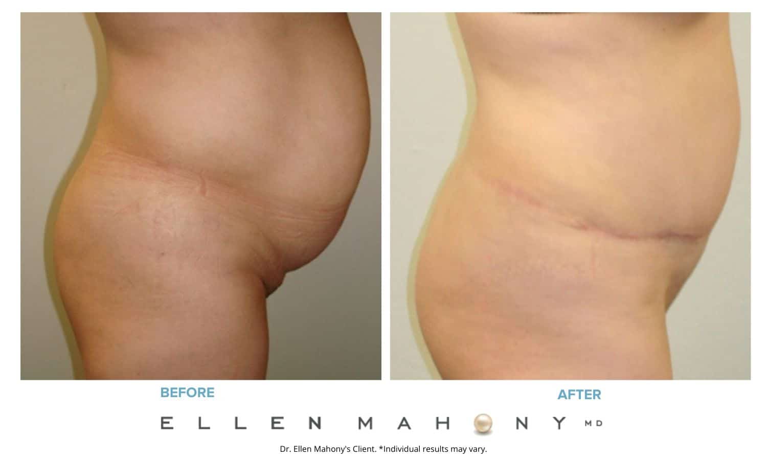 Before and After Image: Case #2498 - right-side