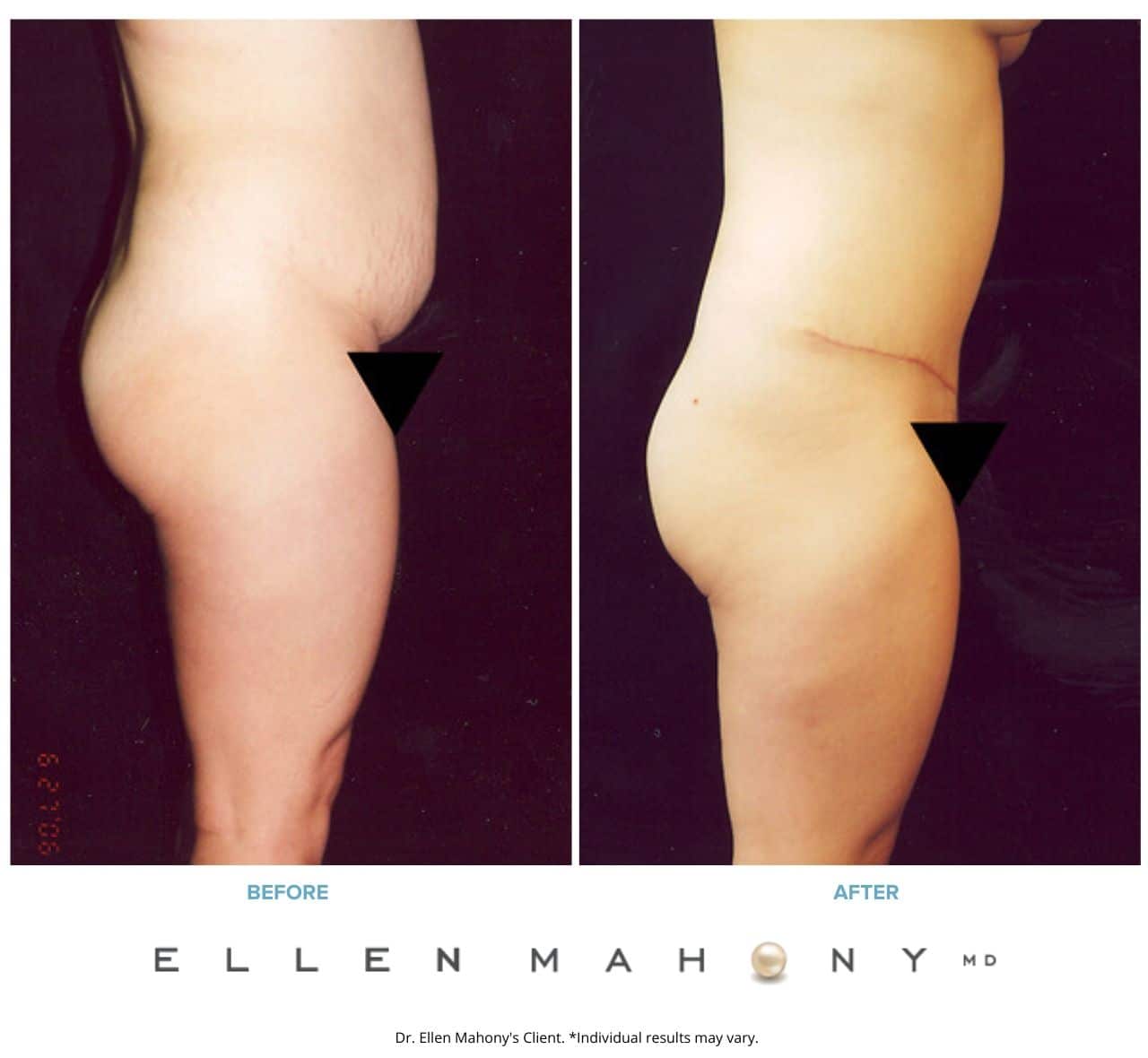 Before and After Image: Case #2519 - right-side