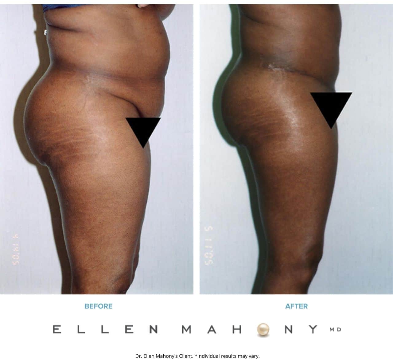 Before and After Image: Case #2524 - right-side