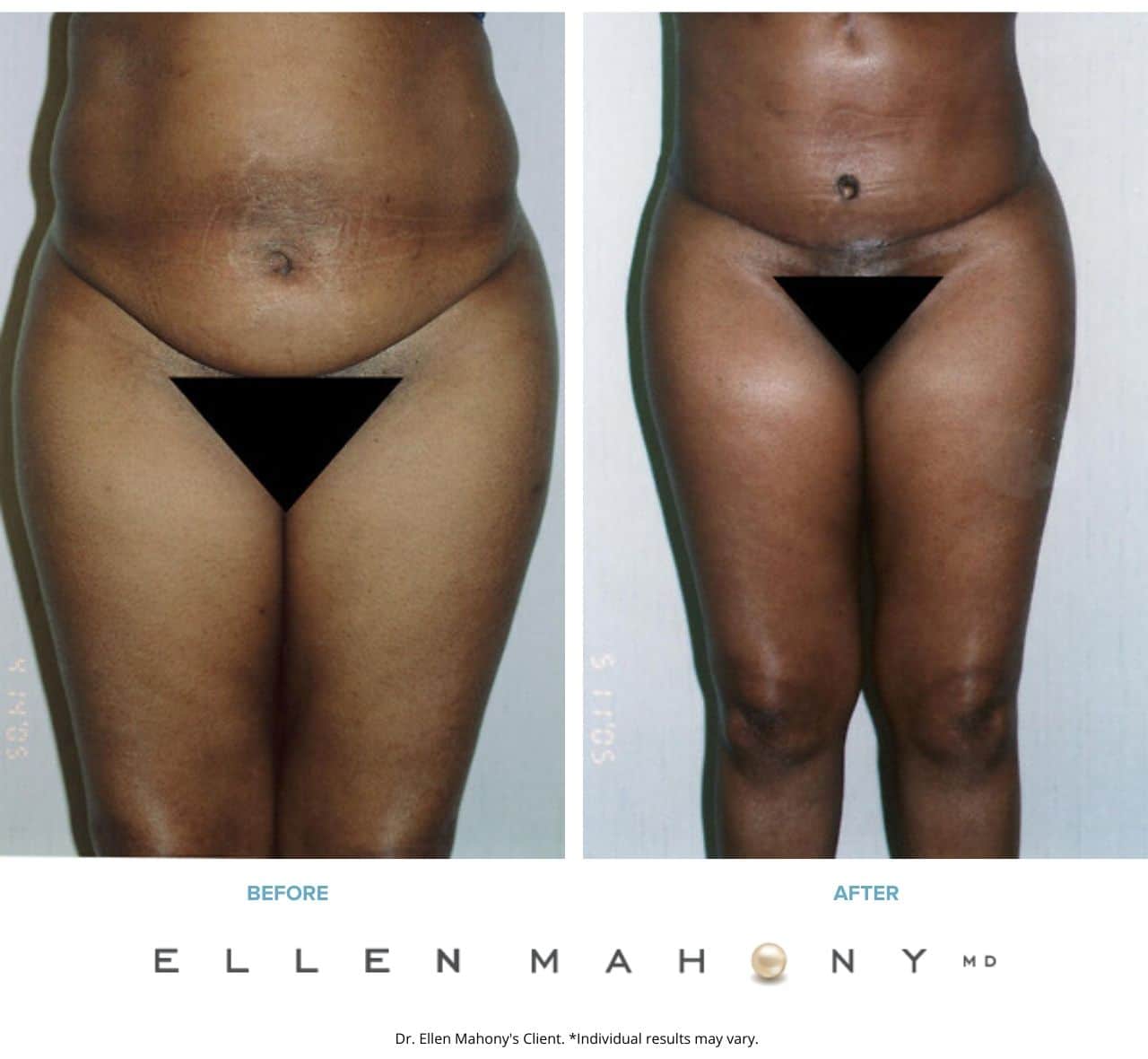 Before and After Image: Case #2524 - right-side
