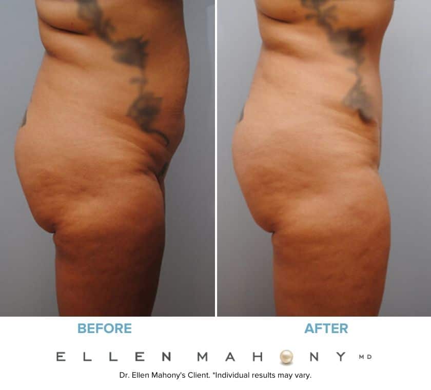 Before and After Image: Case #6048 - right-side
