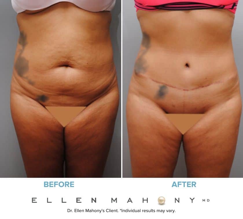 Before and After Image: Case #6048 - front