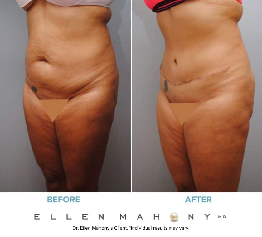 Before and After Image: Case #6048 - left-front-oblique