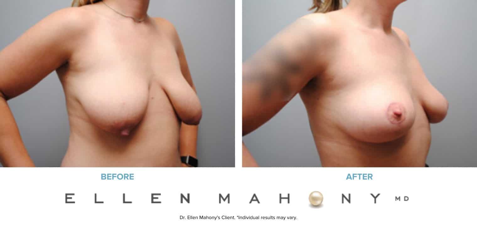Before and After Image: Case #6172 - right-front-oblique