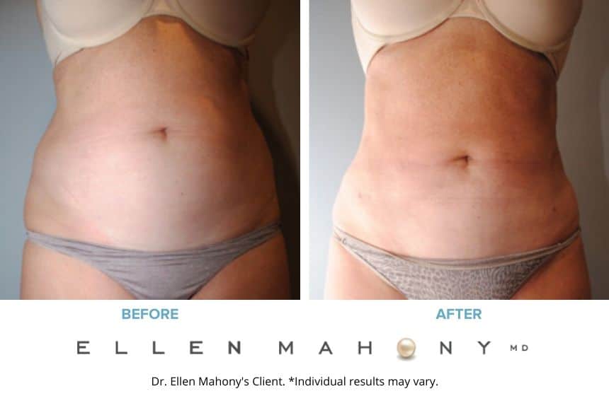 Before and After Image: Case #6465 - front