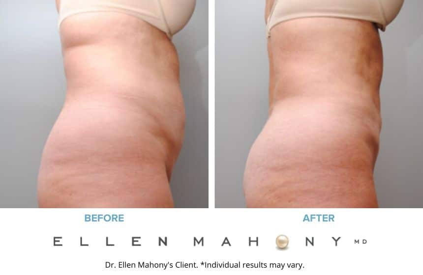 Before and After Image: Case #6465 - right-side