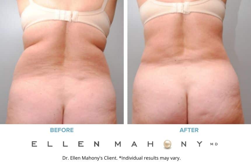 Before and After Image: Case #6465 - back