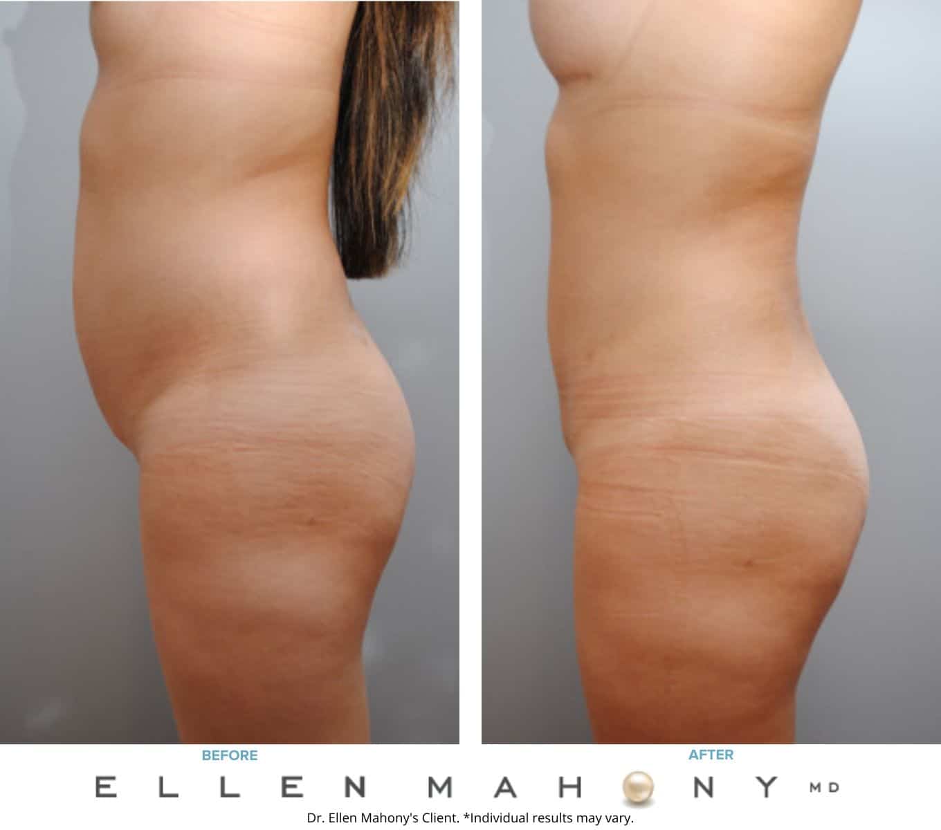 Before and After Image: Case #6499 - left-side