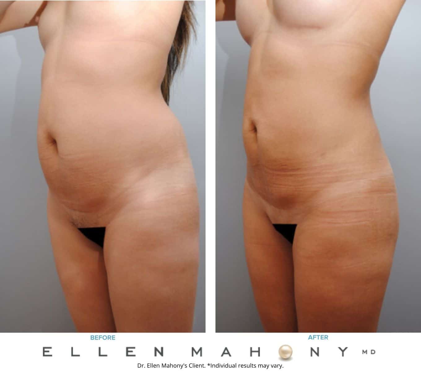 Before and After Image: Case #6499 - left-front-oblique