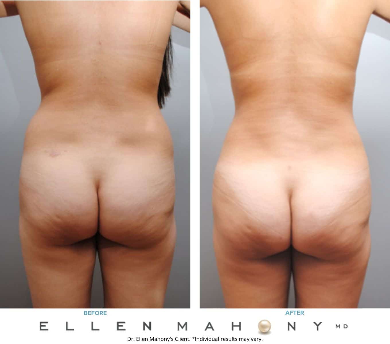 Before and After Image: Case #6499 - back