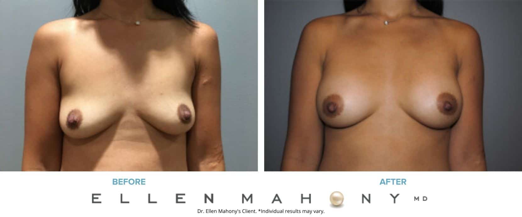 Before and After Image: Case #7503 - front