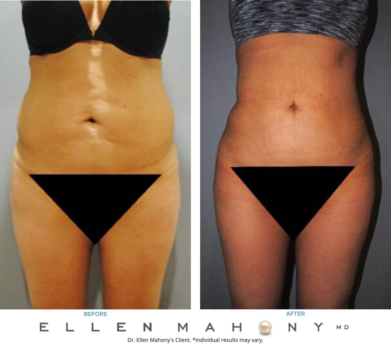 Before and After Image: Case #7713 - front