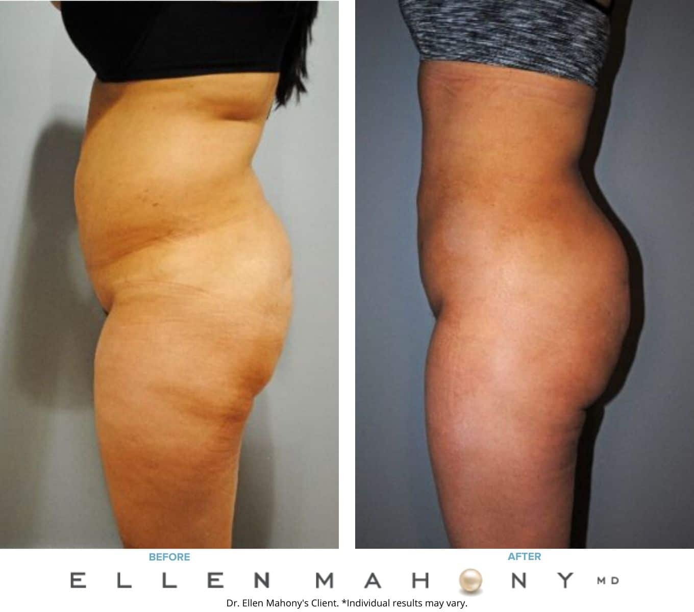 Before and After Image: Case #7713 - left-side