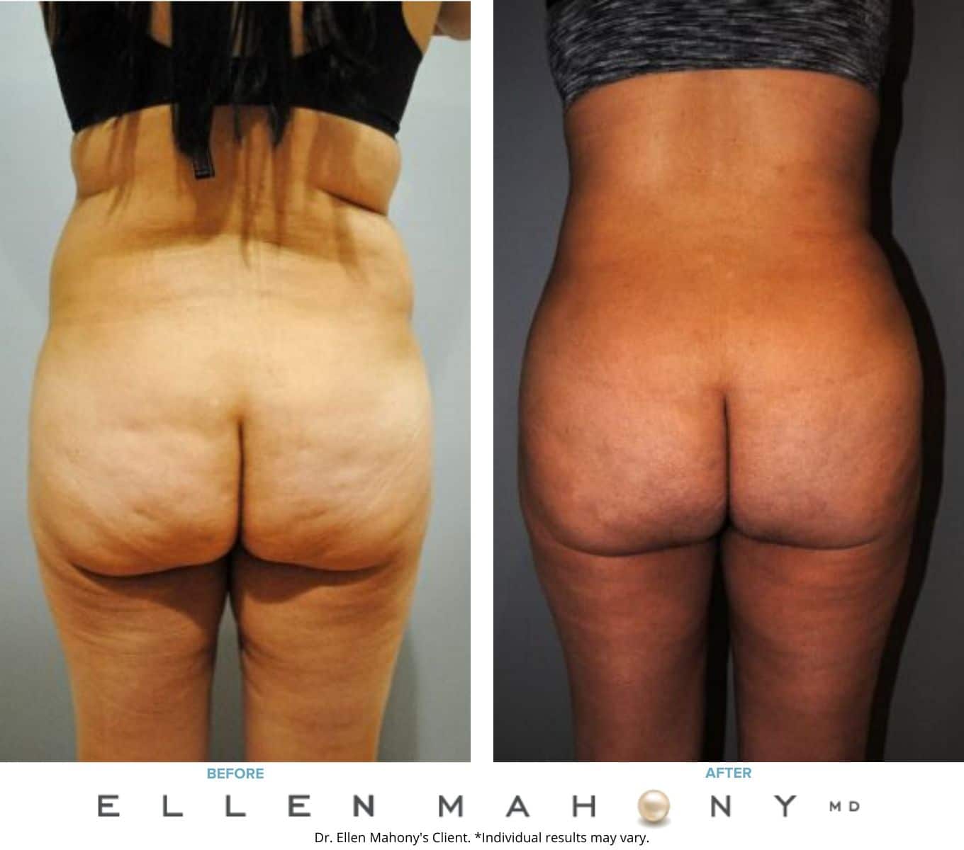 Before and After Image: Case #7713 - back