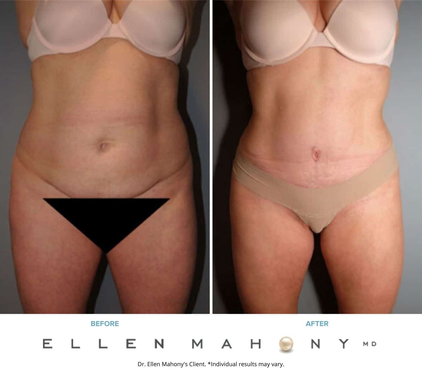 Before and After Image: Case #8030 - front