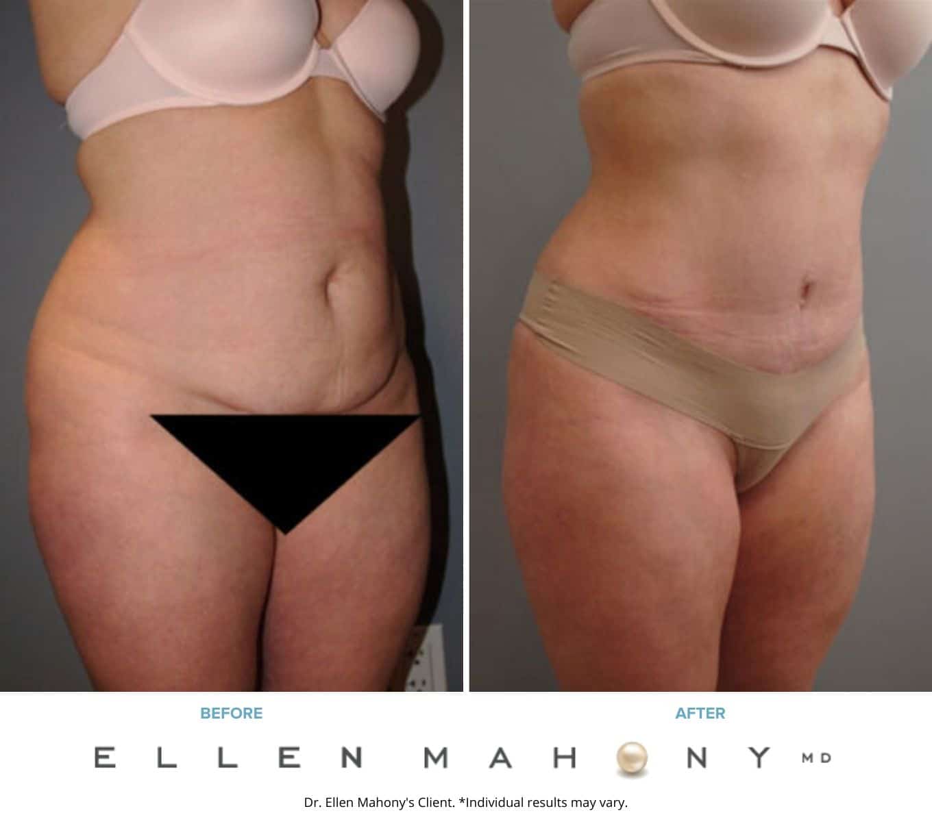 Before and After Image: Case #8030 - right-front-oblique