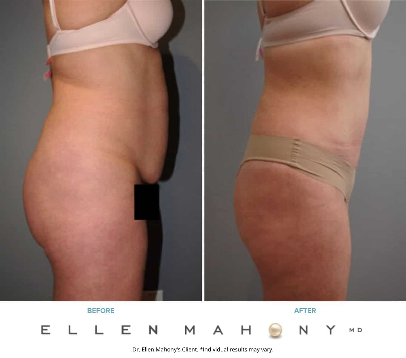 Before and After Image: Case #8030 - right-side