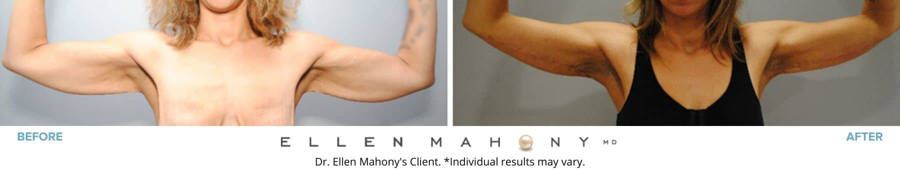 Before and After Image: Case #8585 - front