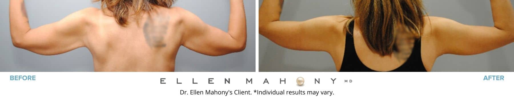Before and After Image: Case #8585 - back