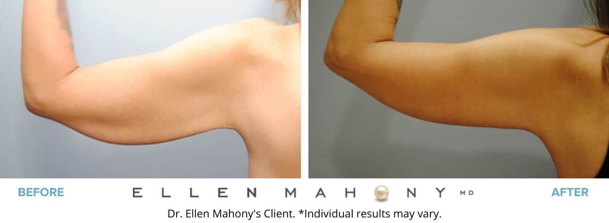 Before and After Image: Case #8585 - back
