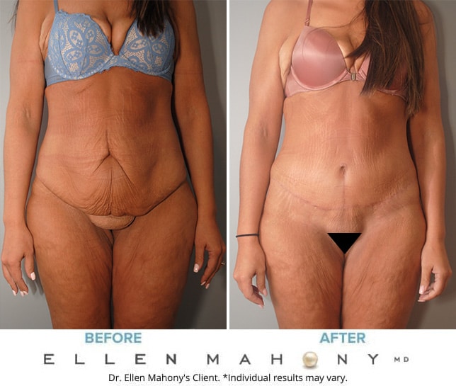 Before and After Image: Case #10056 - front