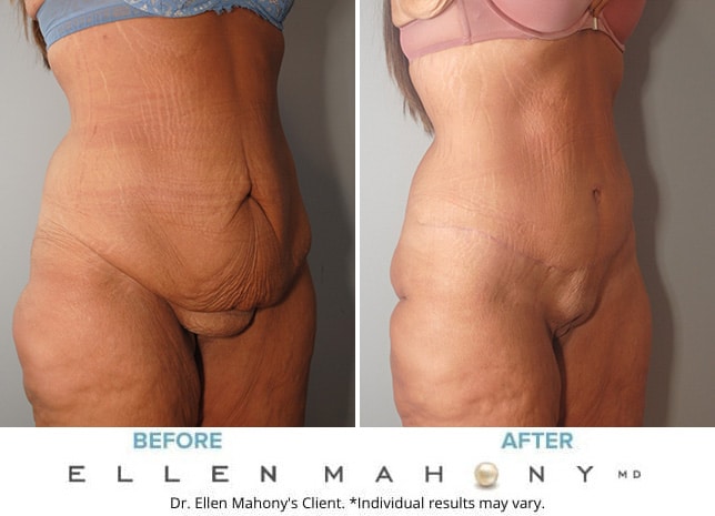 Before and After Image: Case #10056 - right-front-oblique