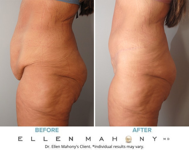 Before and After Image: Case #10056 - left-side