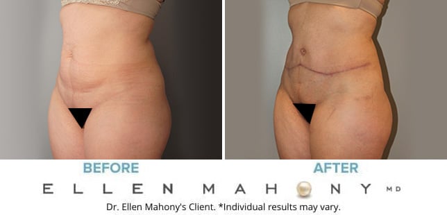 Before and After Image: Case #10251 - left-front-oblique