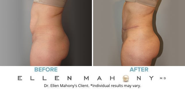 Before and After Image: Case #10251 - left-side