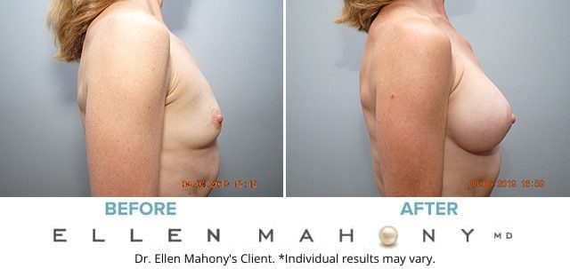 Before and After Image: Case #8078 - right-side