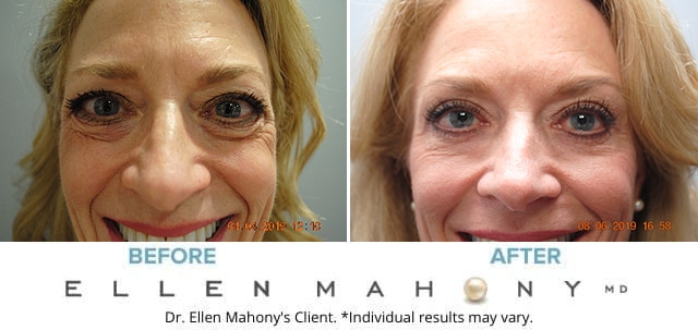 Before and After Image: Case #8078 - front