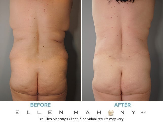 Before and After Image: Case #8347 - back