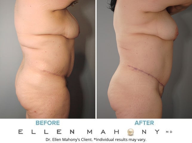Before and After Image: Case #8347 - right-side