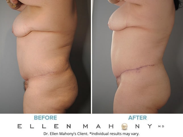 Before and After Image: Case #8347 - left-side