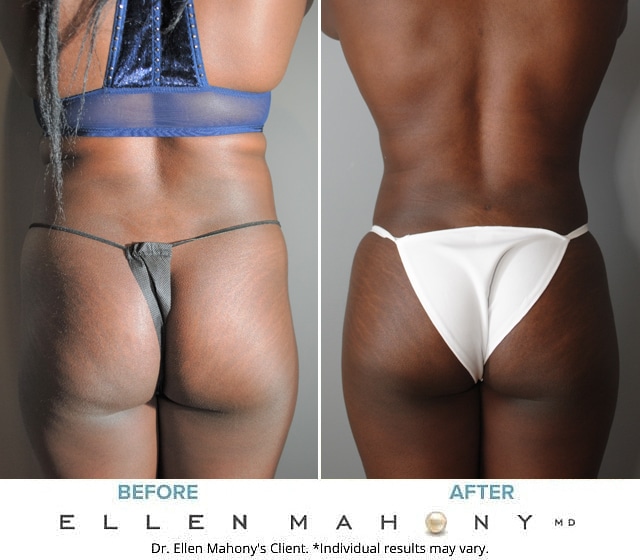 Before and After Image: Case #8894 - back