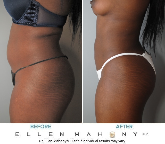 Before and After Image: Case #8894 - left-side