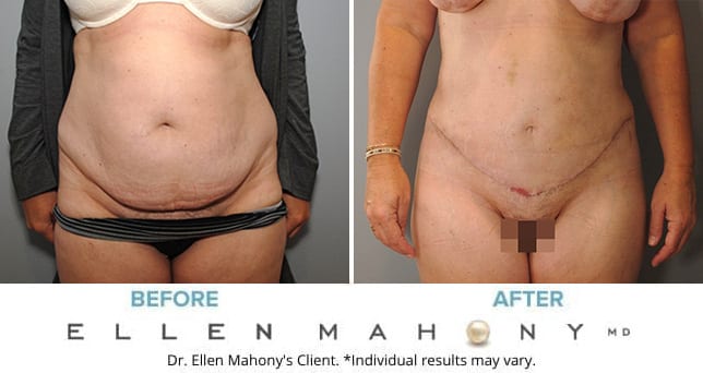 Before and After Image: Case #8976 - front