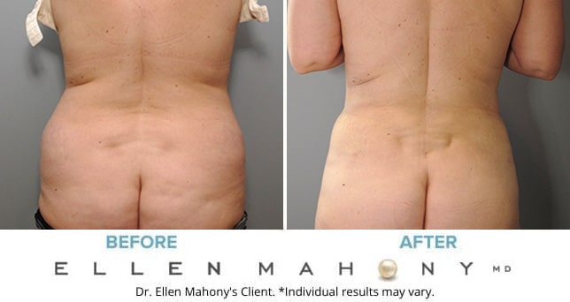 Before and After Image: Case #8976 - back