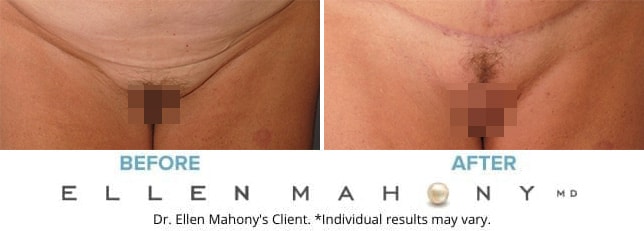 Before and After Image: Case #9182 - front