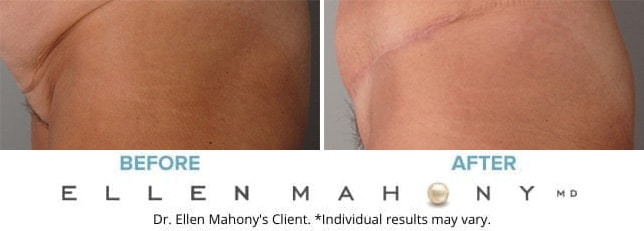 Before and After Image: Case #9182 - left-side