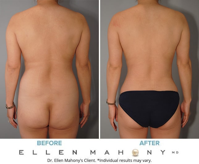 Before and After Image: Case #9195 - back