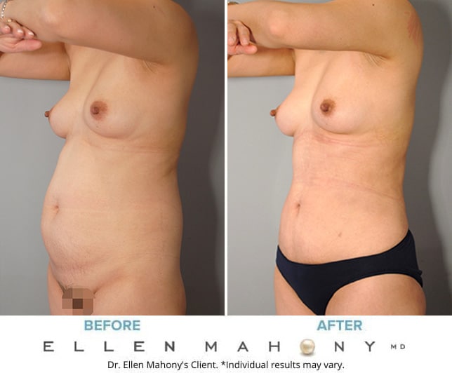 Before and After Image: Case #9195 - left-front-oblique