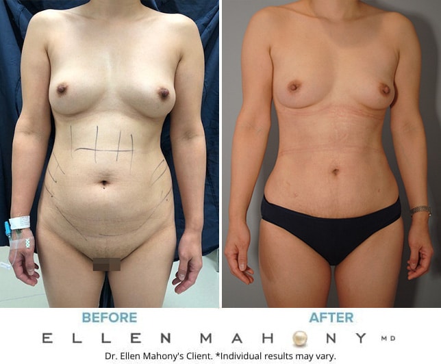 Before and After Image: Case #9195 - back