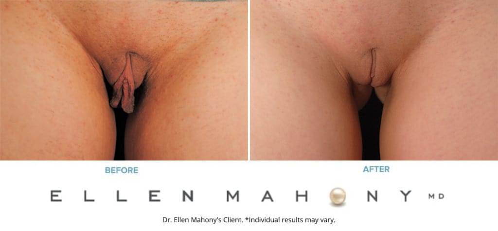 Before and After Image: Case #9287 - front