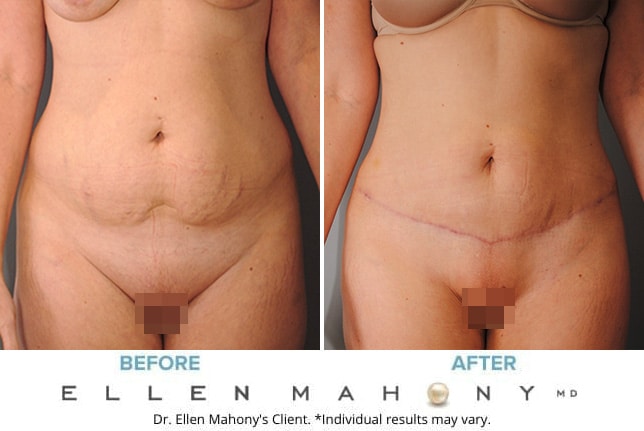 Before and After Image: Case #9278 - front